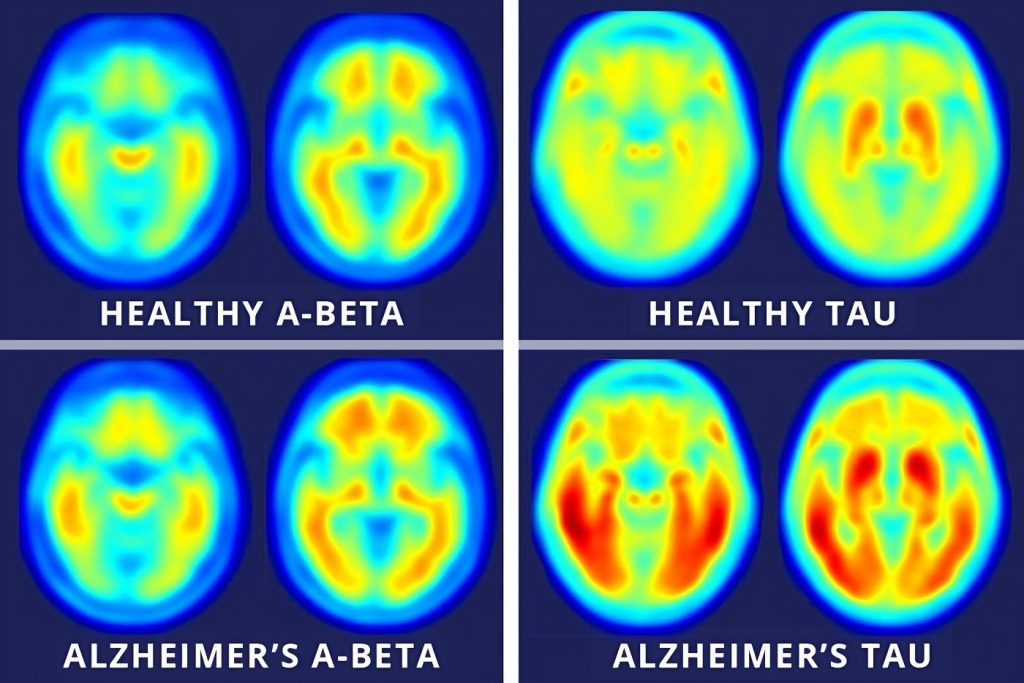 Differenza fra un cervello sano e un cervello affetto da Alzheimer