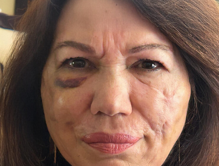 Mirella Serattini, sulla sua pelle i danni causati dal silicone liquido