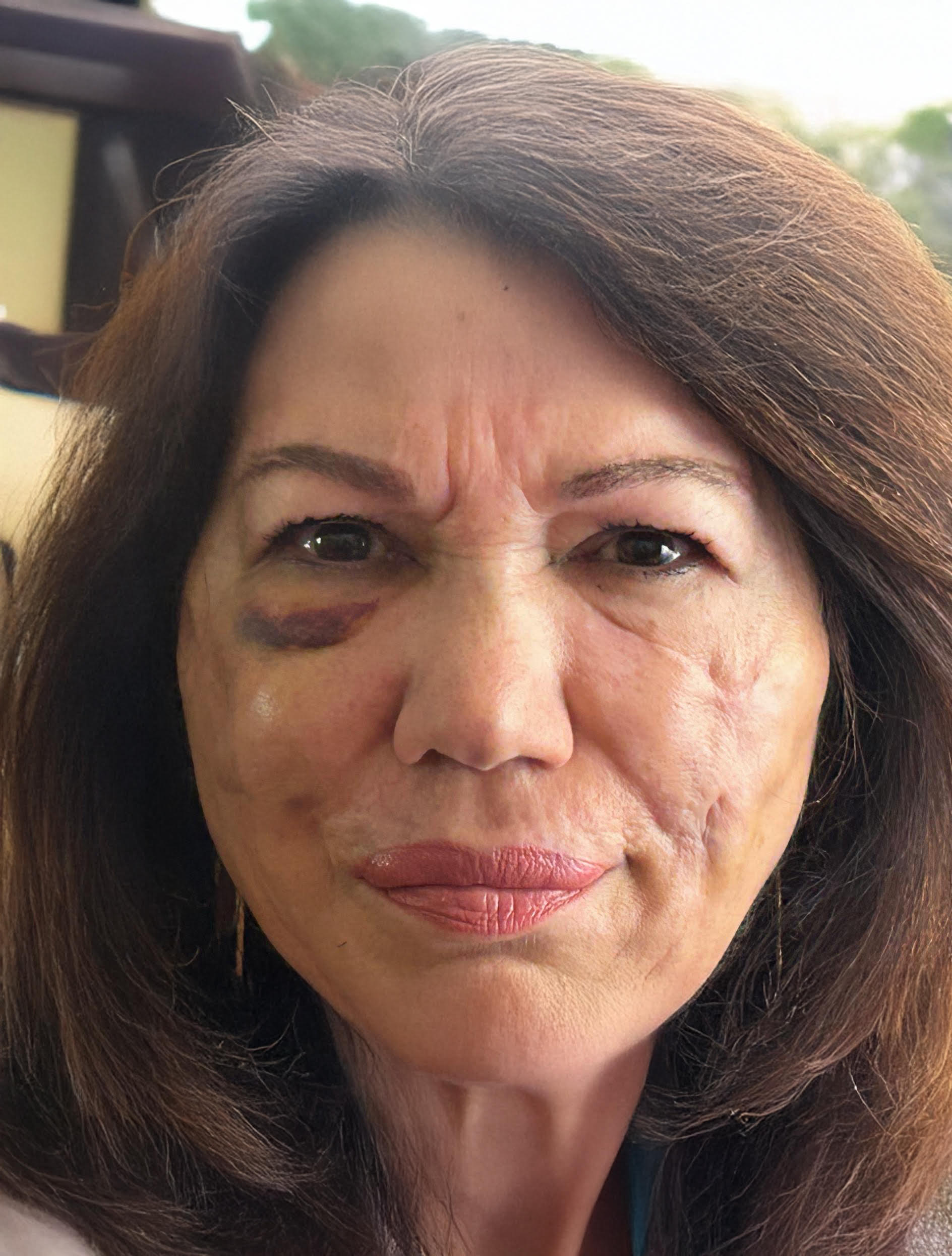 Mirella Serattini, sulla sua pelle i danni causati dal silicone liquido